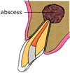 abscess