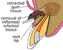 removal