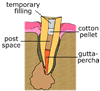 temporary filling